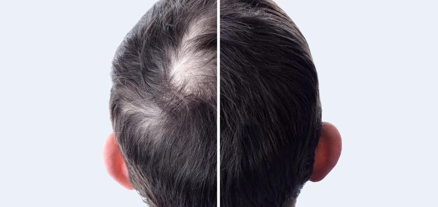 Hair PRP & Hair Transplant