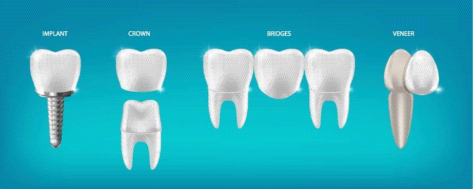 Veneers and Bridges