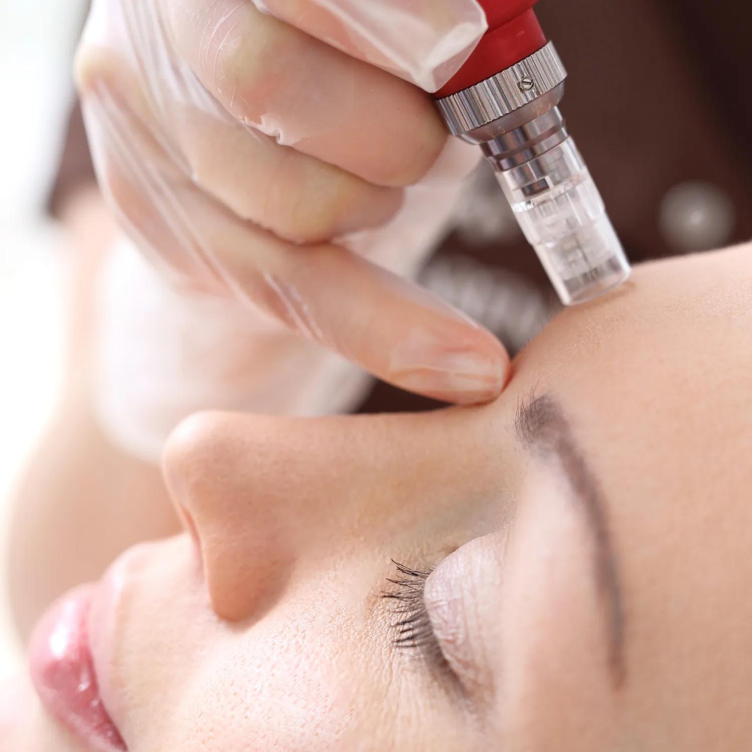 Microneedling