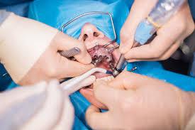 Tooth Surgeries