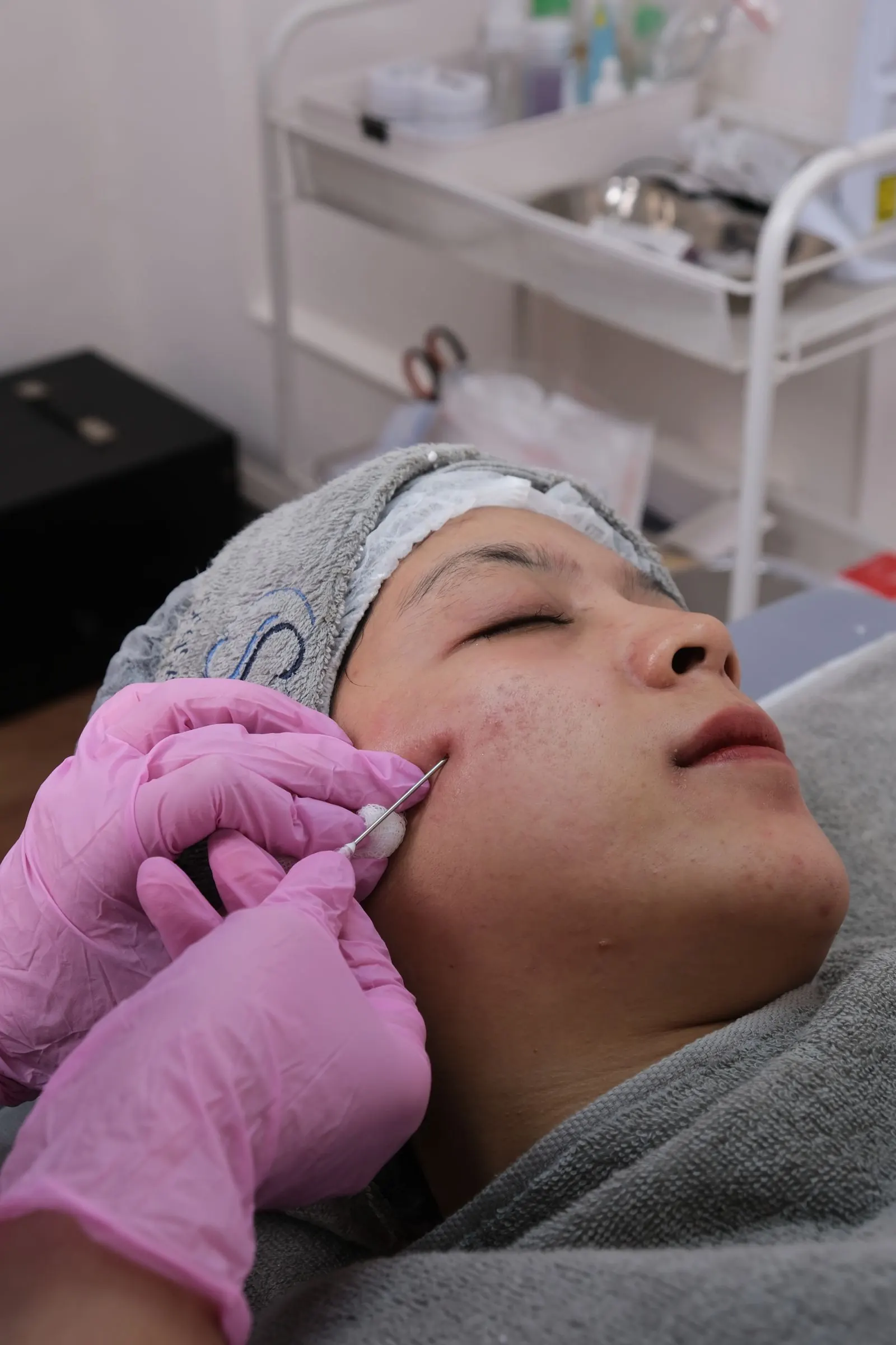 A microneedling treatment on a patient's cheek